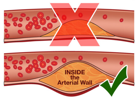 Atherosclerosis is caused by a buildup of plaque IN THE INNER LINING and not merely like sludge in a pipe.